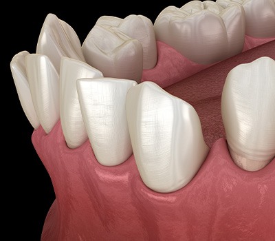 Illustration of gapped teeth