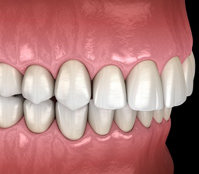 Illustration of an overbite