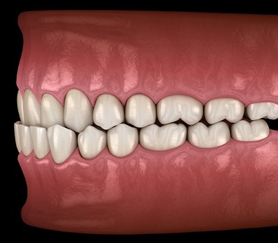 Illustration of an underbite