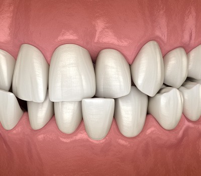 Illustration of a crossbite