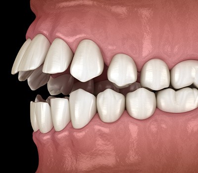 Illustration of an open bite