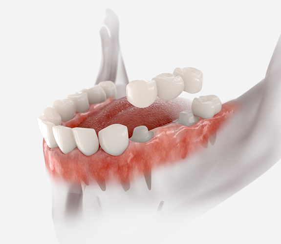 Illustration of a dental bridge replacing one missing tooth