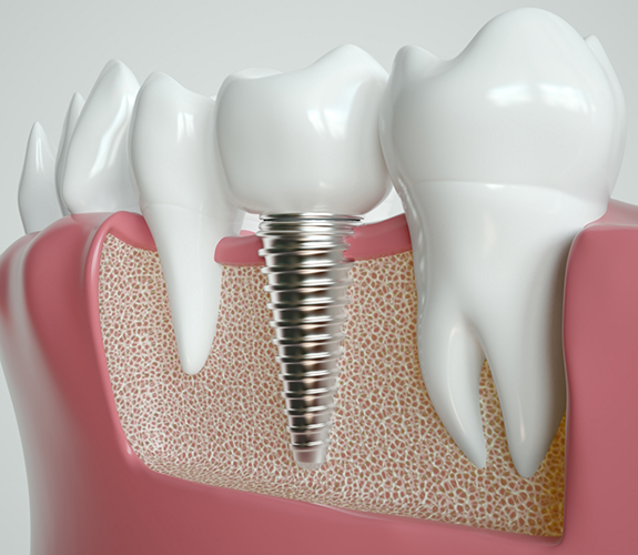 Illustration of a dental implant in the lower jawbone