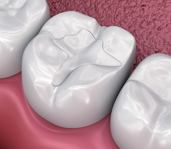 Illustration of a tooth with a white filling