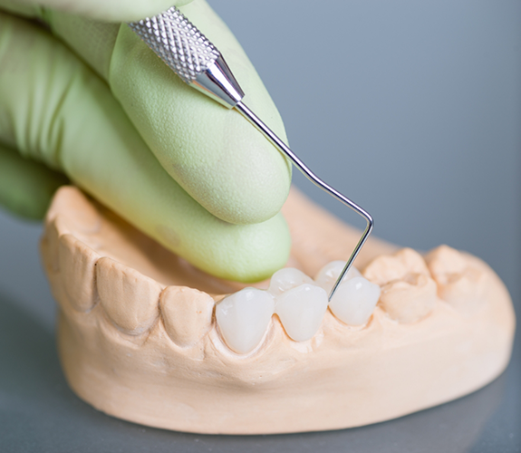 Dentist adjusting a three part dental bridge in a model of the mouth
