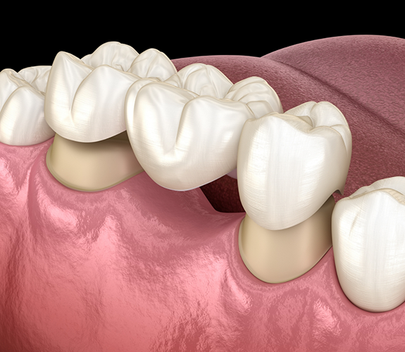 Illustration of a dental bridge being placed over two teeth to replace missing tooth between them