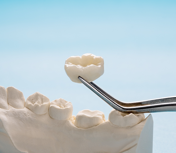 Tweezers holding a dental crown