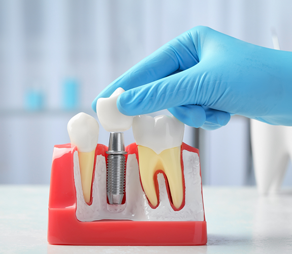 Dentist placing a crown over a model of a dental implant