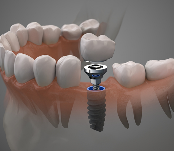 Illustration of a dental crown being fitted over a dental implant