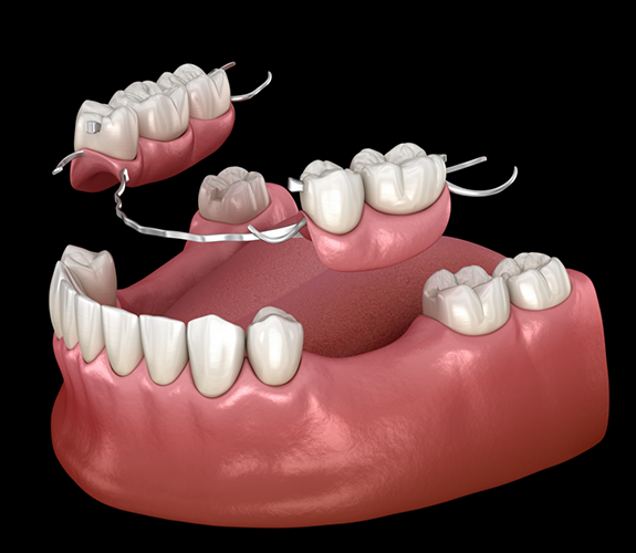 Illustration of a partial denture replacing a few missing teeth along an arch
