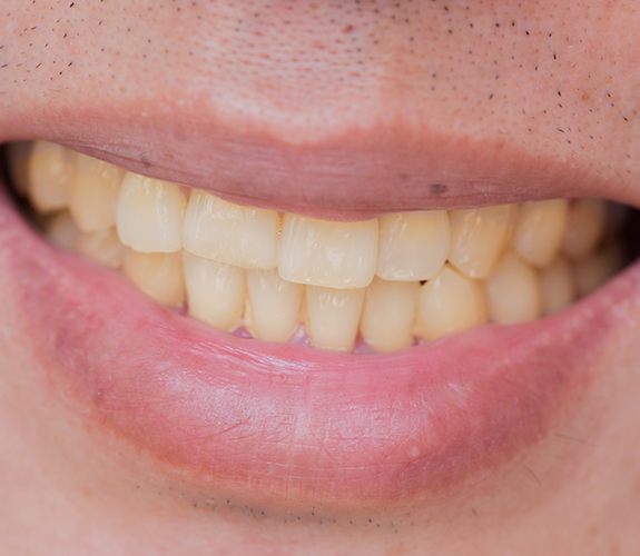 Close up of a smile with yellowed teeth