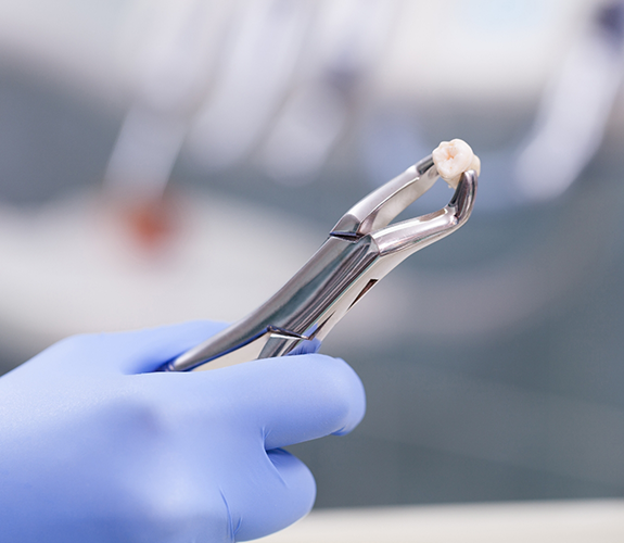 Dental clasp holding an extracted tooth